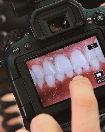 Wie viel kosten Veneers? Preise in den USA pro Zahn und für einen kompletten Satz (2026)