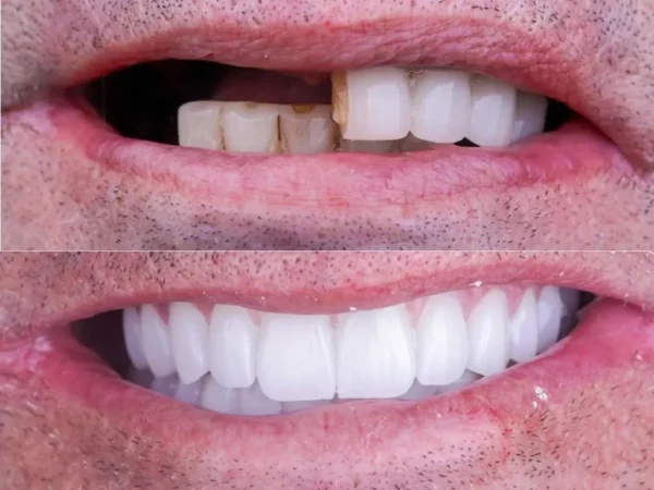 Hollywood Smile: Was es ist, Kosten und wie man es erhält
